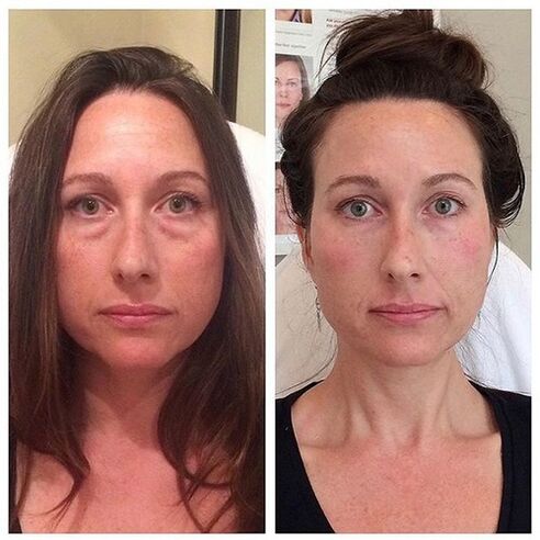 Nenas antes e despois do rexuvenecemento facial con láser