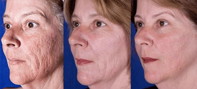 Resultado despois do rexuvenecemento da pel facial por láser