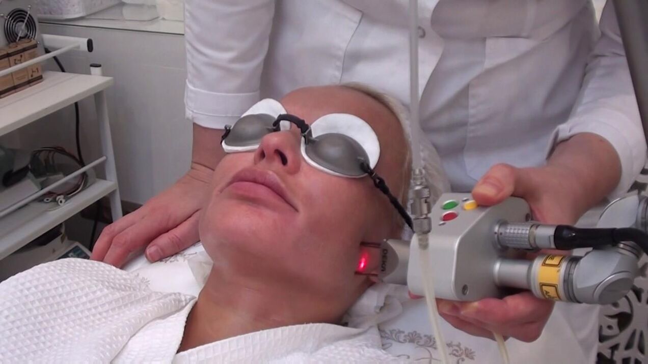Tratamento cun raio láser en áreas problemáticas da pel facial