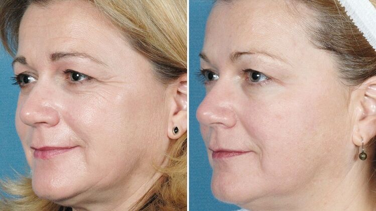 Fotos antes e despois do rexuvenecemento da pel