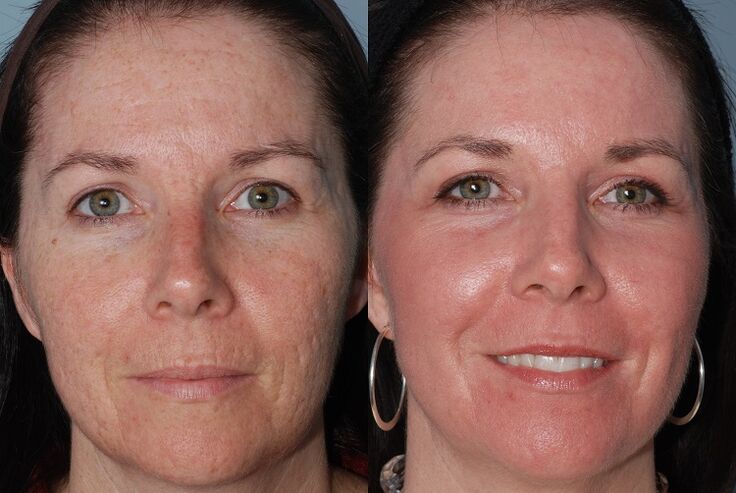 antes e despois do rexuvenecemento da pel
