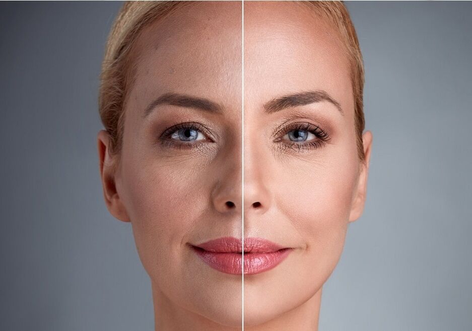 antes e despois do rexuvenecemento facial con láser