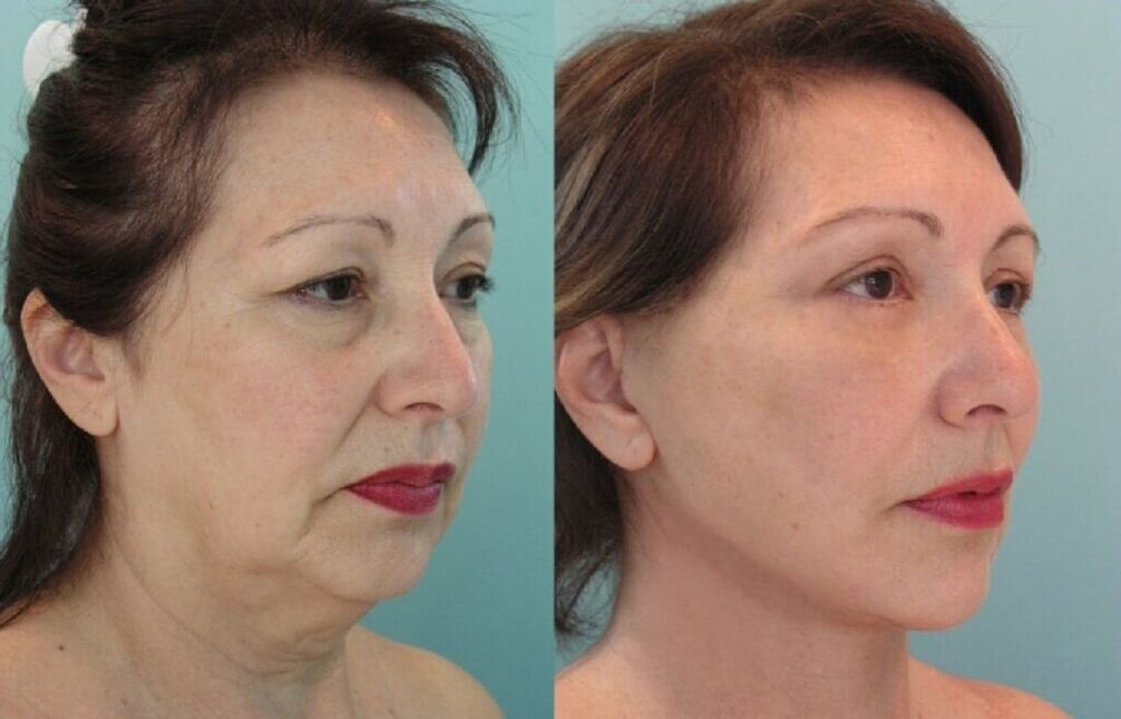 Foto antes e despois do rexuvenecemento da pel